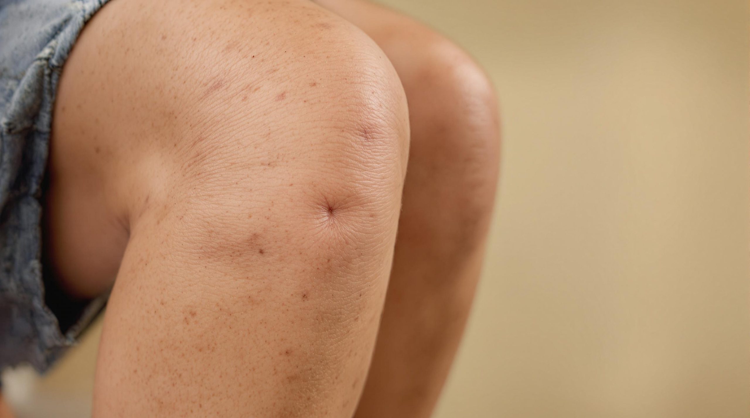 Comprendre et traiter les vergetures au niveau du genou - Fashion Beaute Naturelle