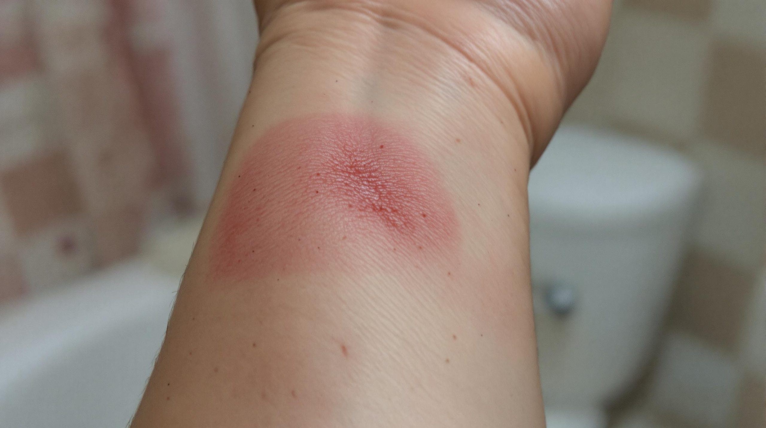 Cicatrice douloureuse après 2 mois : causes et solutions - Fashion Beaute Naturelle